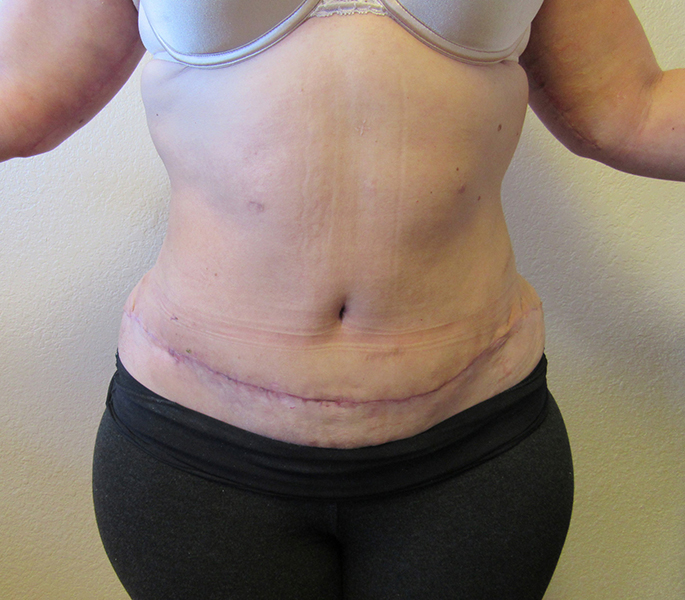 Abdominoplastia - Phoenix, AZ