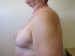 Breast Reduction Patient 10 After - 2 Thumbnail