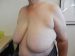 Breast Reduction Patient 12 Before - 2 Thumbnail