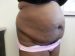 Tummy Tuck Patient 04 Before - 5 Thumbnail