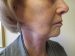 Neck Lift Patient 01 After - 4 Thumbnail