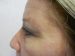 Blepharoplasty Patient 01 Before - 2 Thumbnail