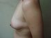 Breast Lift & Augmentation Patient 1 Before - 2 Thumbnail