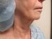 Neck Lift Patient 01 Before - 4 Thumbnail