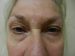 Blepharoplasty Patient 02 Before Thumbnail