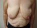 Breast Lift & Augmentation Patient 2 Before Thumbnail