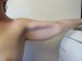 Arm Lift Patient 02 Before - 2 Thumbnail