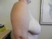 Breast Reduction Patient 03 Before - 4 Thumbnail