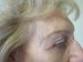 Blepharoplasty Patient 04 After - 2 Thumbnail