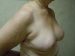Breast Reduction Patient 4 After - 5 Thumbnail