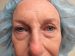 Blepharoplasty Patient 04 Before Thumbnail