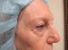 Blepharoplasty Patient 04 Before - 2 Thumbnail