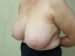 Breast Reduction Patient 4 Before - 3 Thumbnail