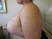 Breast Reduction Patient 5 After - 2 Thumbnail