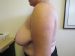 Breast Reduction Patient 5 Before - 2 Thumbnail
