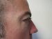 Blepharoplasty Patient 05 Before - 3 Thumbnail