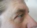 Blepharoplasty Patient 06 After - 4 Thumbnail