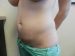 Tummy Tuck Patient 03 Before - 3 Thumbnail