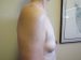 Breast Augmentation Patient 06 Before - 4 Thumbnail