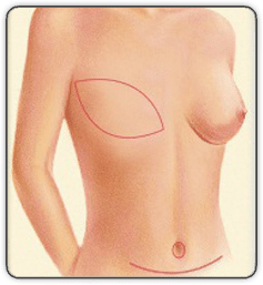 breast reconstruction animated diagram B