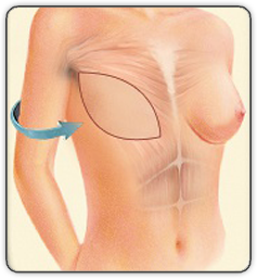 breast reconstruction animated diagram D