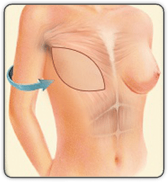 breast reconstruction animated diagram D