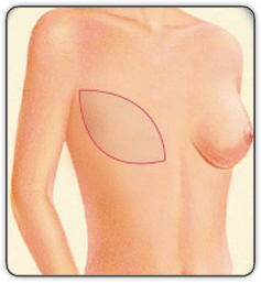 breast reconstruction animated diagram F