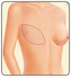 breast reconstruction animated diagram F