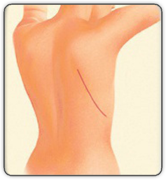 breast reconstruction animated diagram E
