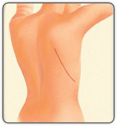 breast reconstruction animated diagram E