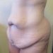 Body Lift Patient 01 Before - 4 Thumbnail