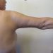 Arm Lift Patient 04 After - 3 Thumbnail