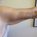 Arm Lift Patient 04 Before - 3 Thumbnail