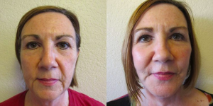 Dr. Boll - Cathy - Facelift patient