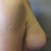 Breast Augmentation Patient 11 After - 3 Thumbnail