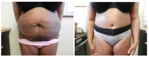 Dr Boll Tummy Tuck Patient Before and After