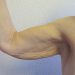 Arm Lift Patient 05 Before Thumbnail