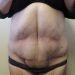 Tummy Tuck Patient 05 After Thumbnail