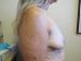 Breast Lift & Augmentation Patient 3 Before - 2 Thumbnail
