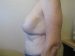 Breast Lift & Augmentation Patient 4 After - 2 Thumbnail