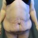 Body Lift Patient 04 Before Thumbnail