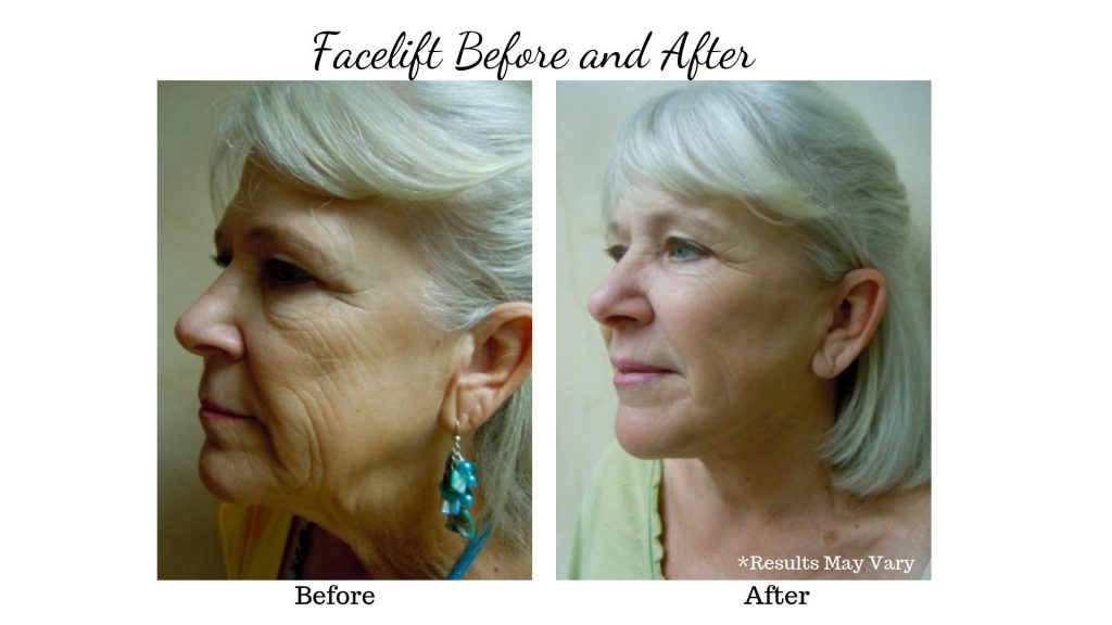 Before and After photos of Facelift Patient