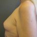Breast Augmentation Patient 15 Before - 3 Thumbnail