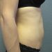 Tummy Tuck Patient 06 Before - 4 Thumbnail