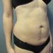 Tummy Tuck Patient 06 Before - 3 Thumbnail