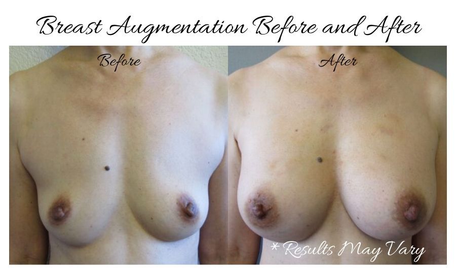 Breast Augmentation before and after results