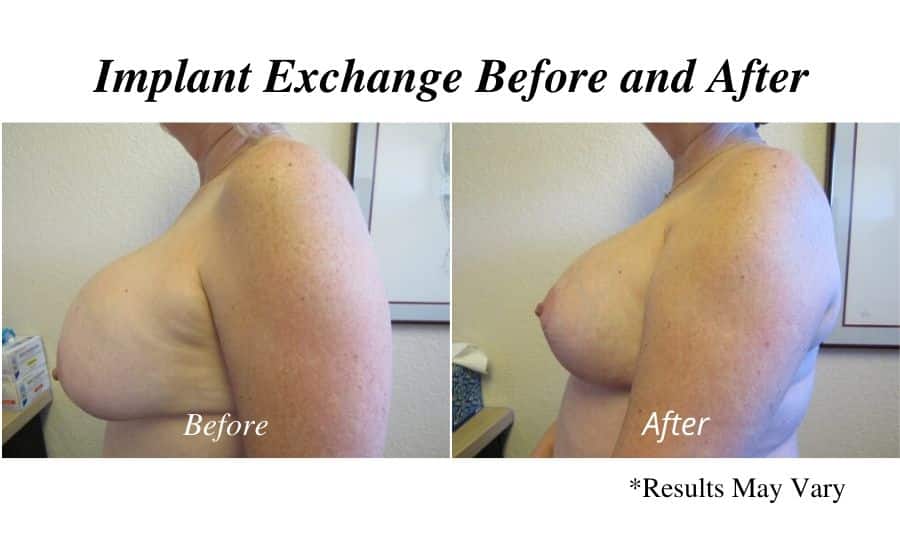 Before and after image showing the results of a breast implant exchange performed in Tempe, AZ.