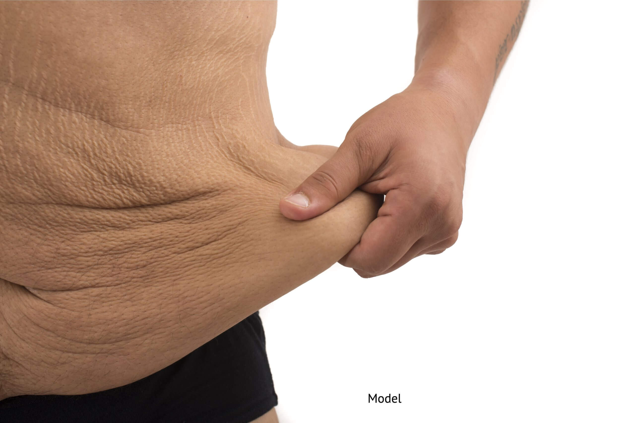 man with excess skin on the abdomen who could benefit from skin removal surgery