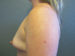 Breast Augmentation Patient 17 Before - 5 Thumbnail