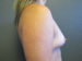 Breast Augmentation Patient 17 Before - 3 Thumbnail